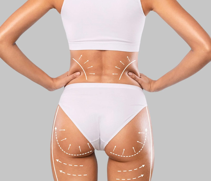 Brazilian Butt Lift (BBL) Nedir Doğal Görünümlü Kalça Estetiği