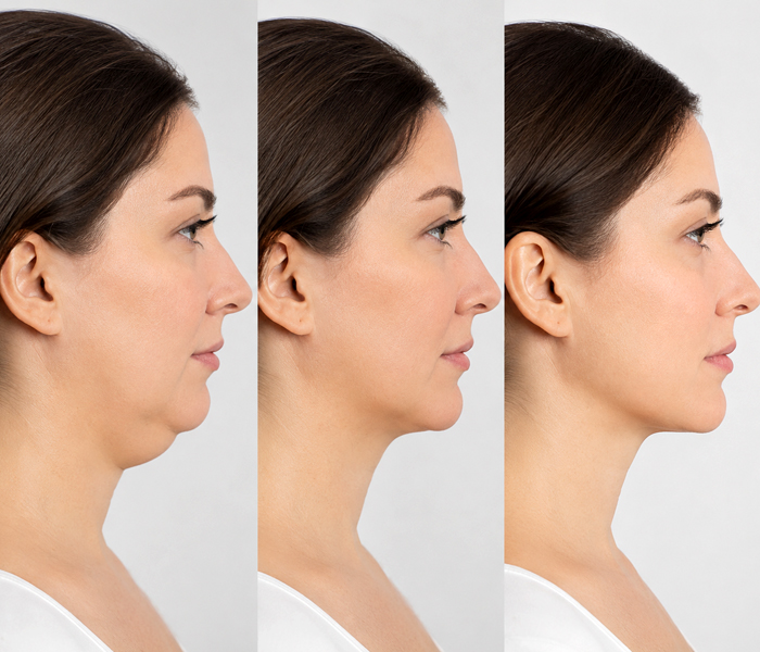 Gıdı Estetiği Sonrası Tekrar Gıdı Oluşur mu? - Op. Dr. Şükrü İşler Estetik Kliniği Gıdı Estetiği Sonrası Tekrar Gıdı Oluşur mu