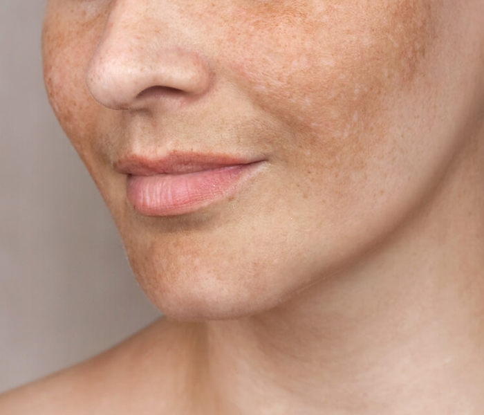 Sunspots - Post-Summer Skin Rejuvenation Methods - Op. Dr. Şükrü İşler Estetik Kliniği Sunspots - Post-Summer Skin Rejuvenation Methods