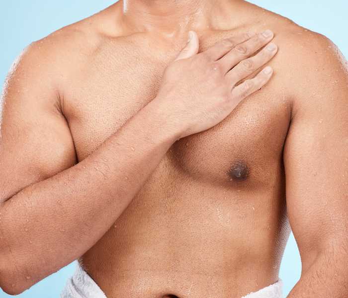 Gynäkomastie oder Fetteinlagerung? Wie erkennt man Brustvergrößerung bei Männern? - Op. Dr. Şükrü İşler Estetik Kliniği Gynäkomastie oder Lipomastie – Wie man Brustvergrößerung erkennt