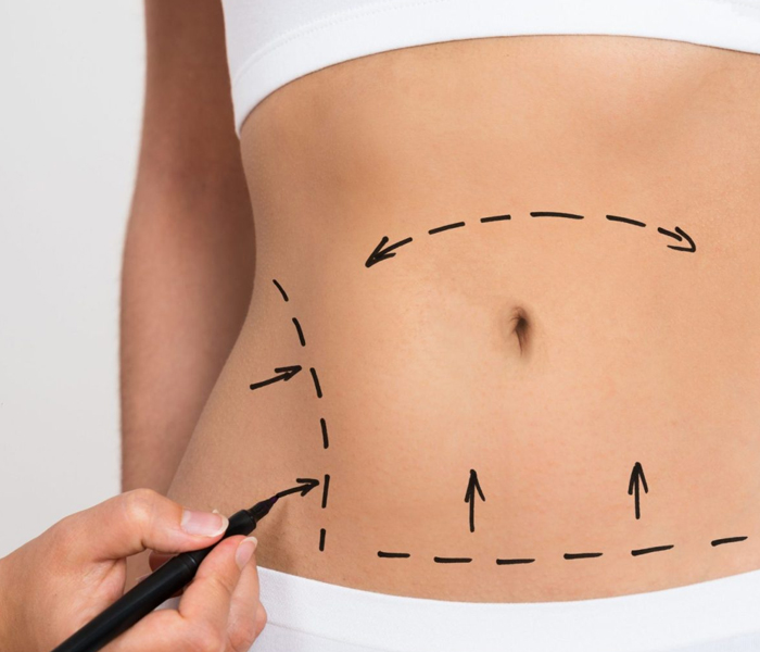 Bauchstraffung oder Liposuktion? Was ist das Richtige für Sie? - Op. Dr. Şükrü İşler Estetik Kliniği Bauchstraffung oder Liposuktion – Was ist das Richtige für Sie?