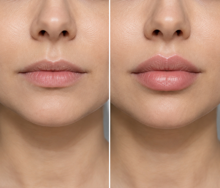 Lip Lift Nedir? Dudak Dolgusundan Farkı Nedir? - Op. Dr. Şükrü İşler Estetik Kliniği Lip Lift Nedir