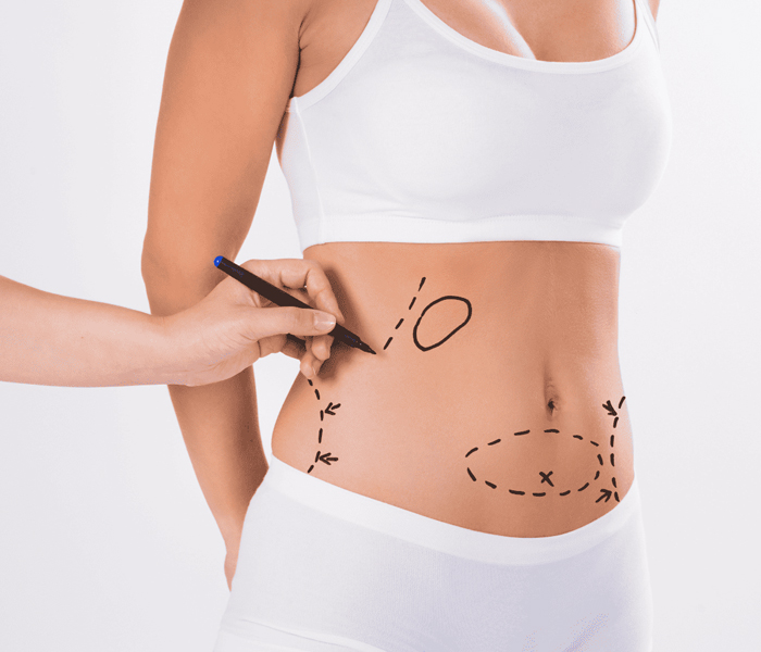 Liposakşın Sonrası Yağlar Tekrar Oluşur mu? - Op. Dr. Şükrü İşler Estetik Kliniği Liposakşın Sonrası Yağlar Tekrar Oluşur mu