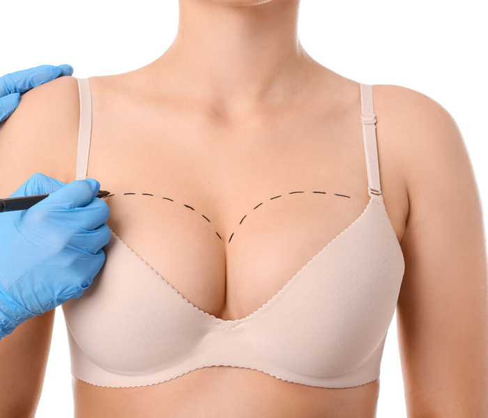 Breast Augmentation or Breast Lift? Which One Is Right for You? - Op. Dr. Şükrü İşler Estetik Kliniği Breast Augmentation or Breast Lift? Which One Is Right for You?